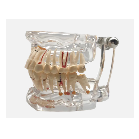 32 Tooth Full Mouth Transparent Impant Disease Teeth Model